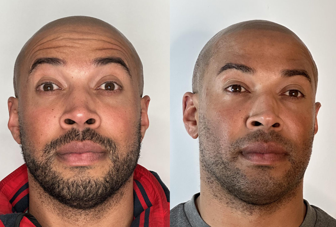 RefineAesthetics-B&A-AntiWrinkle1